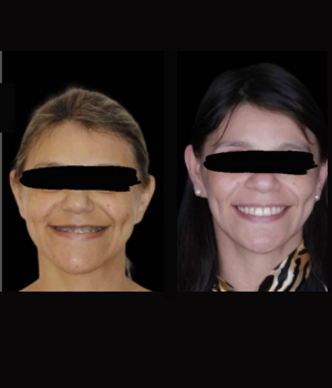 Bucomaxilofacial Frederico Felipe antes e depois